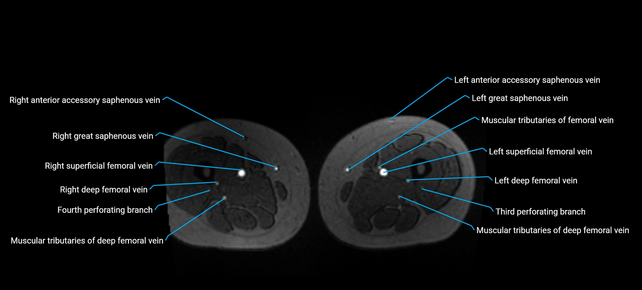 MRV abdomen pelvis & lower limb axial cross sectional anatomy labelled MRI image 270 (1).webp